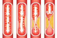 Атеросклероз сосудов нарушает кровоснабжение жизненно важных органов.