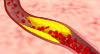 Атеросклероз вызывает сужение просвета сосудов питающих сердце, что приводит к присупам стенокардии.